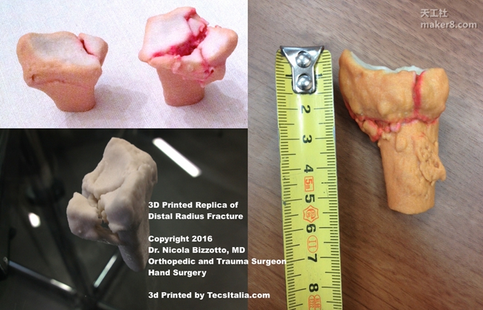 3D打印如何輔助醫療 3D打印手術應用的那些事兒

醫療3D打印,3D打印醫療,3D打印應用,3D打印領域,3D打印有哪些好處,3D打印的優勢